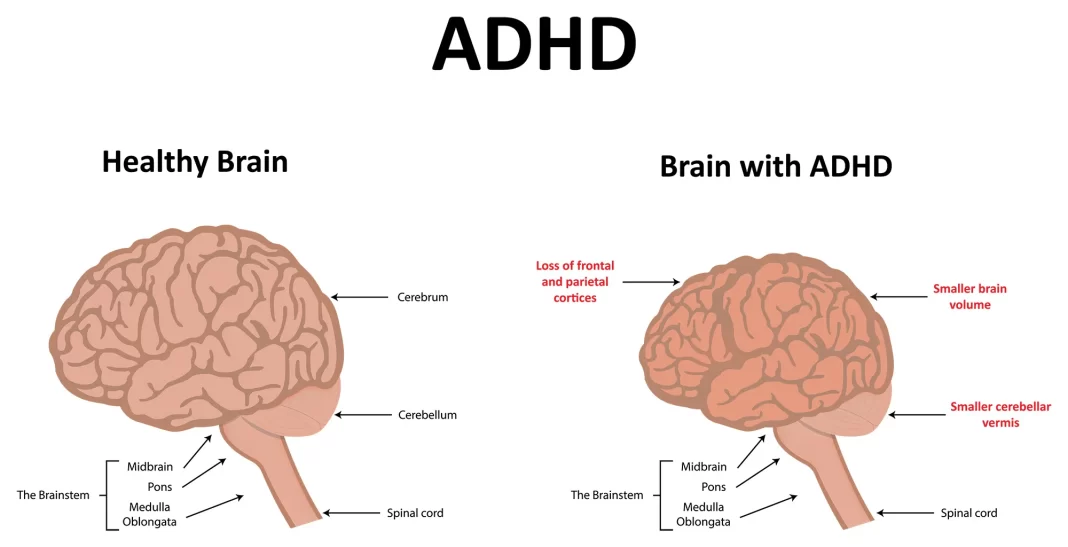 Understanding ADHD: Symptoms, Causes, and Treatment Options